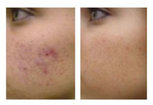microneedling avant-apres acné